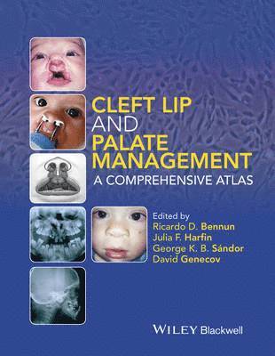 Cleft Lip and Palate Management 1