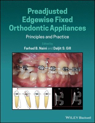 Farhad B. Naini, Daljit S. Gill - Preadjusted Edgewise Fixed Orthodontic Appliances, Inbunden