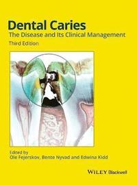 bokomslag Dental Caries: The Disease and its Clinical Management, 3rd Edition