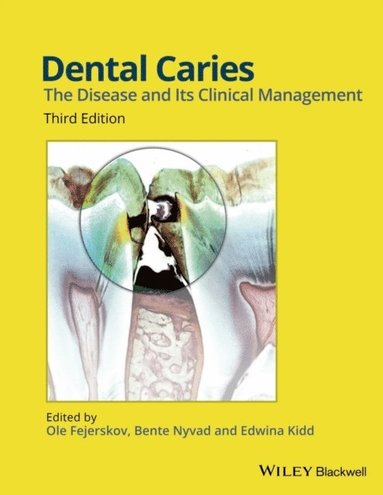 bokomslag Dental Caries: The Disease and its Clinical Management, 3rd Edition
