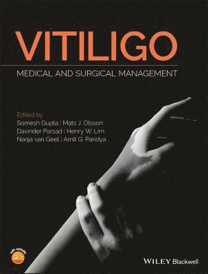 Vitiligo 1