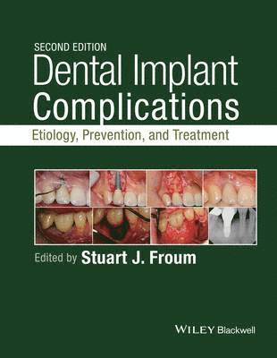 bokomslag Dental Implant Complications