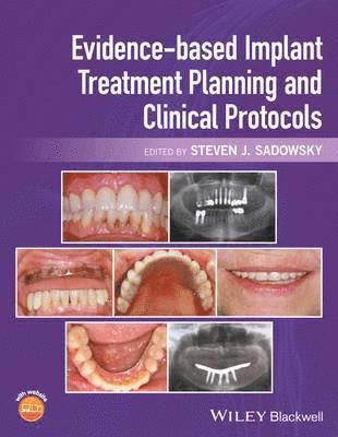 Evidence-based Implant Treatment Planning and Clinical Protocols 1