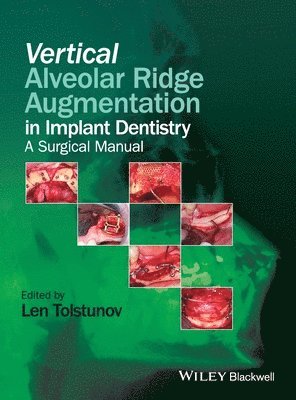 Vertical Alveolar Ridge Augmentation in Implant Dentistry - A Surgical Manual 1