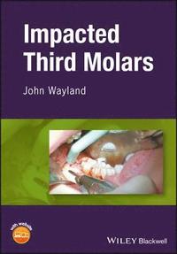 bokomslag Impacted Third Molars