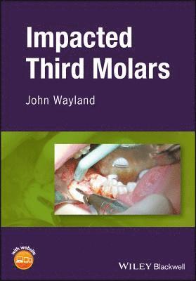 bokomslag Impacted Third Molars