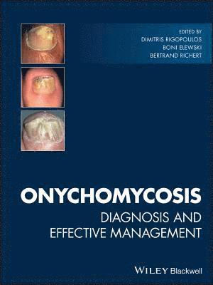 Dimitris Rigopoulos, Boni Elewski, Bertrand Richert - Onychomycosis, Inbunden
