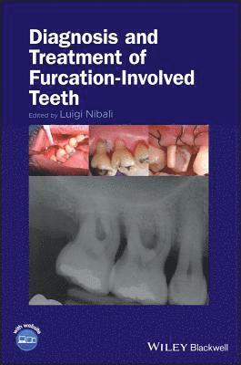 Luigi Nibali - Diagnosis and Treatment of Furcation-Involved Teeth, Inbunden