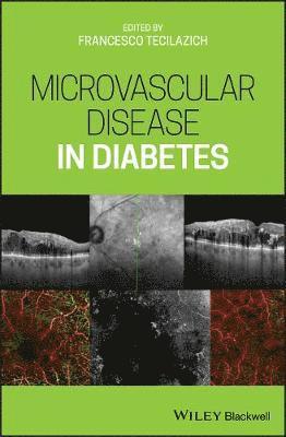 Microvascular Disease in Diabetes 1