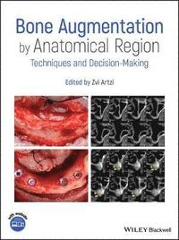 bokomslag Bone Augmentation by Anatomical Region