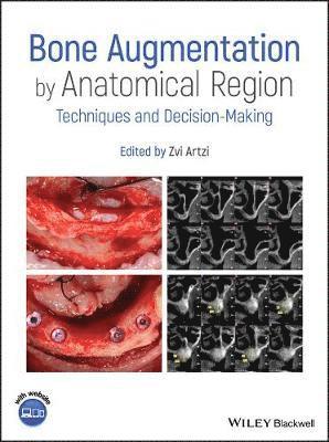 Bone Augmentation by Anatomical Region 1