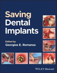 bokomslag Saving Dental Implants