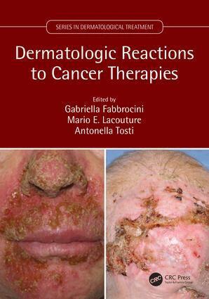 Gabriella Fabbrocini, Mario Lacouture, Antonella Tosti - Dermatologic Reactions to Cancer Therapies, Häftad