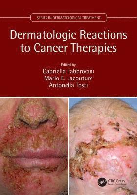 Dermatologic Reactions to Cancer Therapies 1