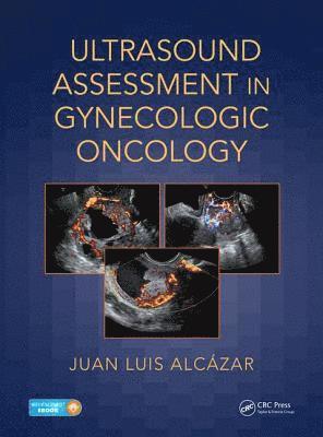 bokomslag Ultrasound Assessment in Gynecologic Oncology