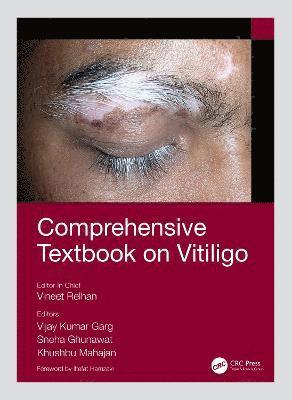 Comprehensive Textbook on Vitiligo 1