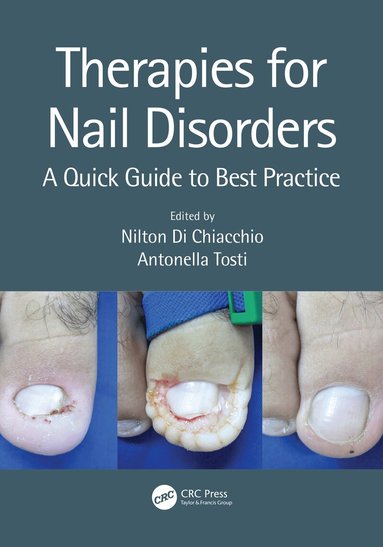 Nilton Di Chiacchio, Antonella Tosti - Therapies for Nail Disorders, Häftad