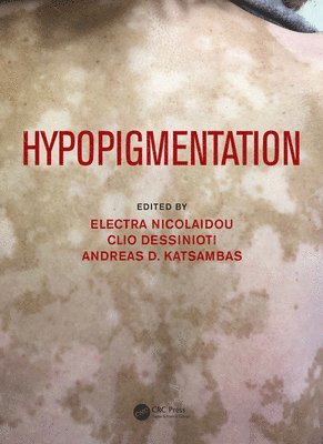 Hypopigmentation 1