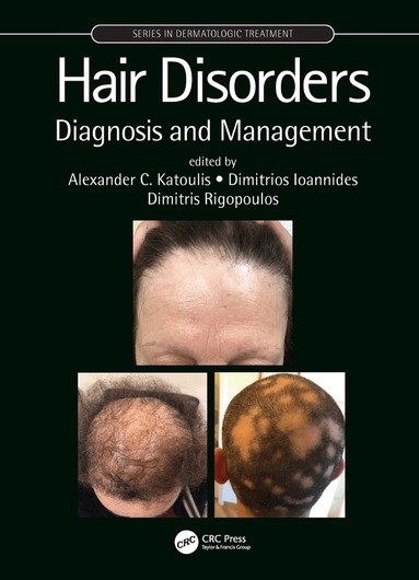 Alexander C. Katoulis, Dimitrios Ioannides, Dimitris Rigopoulos - Hair Disorders, Inbunden