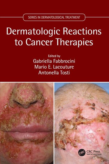 Gabriella Fabbrocini, Mario Lacouture, Antonella Tosti - Dermatologic Reactions to Cancer Therapies, Inbunden