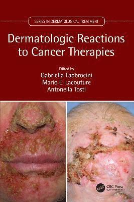 bokomslag Dermatologic Reactions to Cancer Therapies