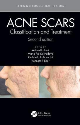 Antonell Tosti, Maria Pia De Padova, Gabriella Fabbrocini, Kenneth Beer - Acne Scars, Inbunden