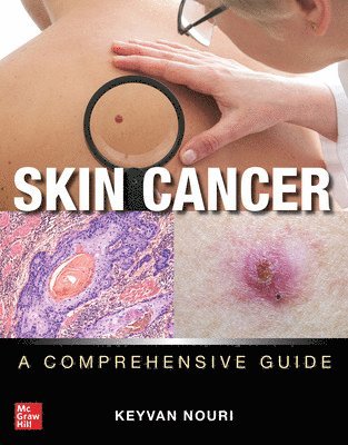 Skin Cancer: A Comprehensive Guide 1