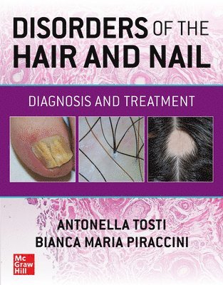 Antonella Tosti, Bianca Maria Piraccini - Disorders of the Hair and Nail: Diagnosis and Treatment, Häftad