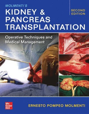 Molmenti's Kidney and Pancreas Transplantation: Operative Techniques and Medical Management 1