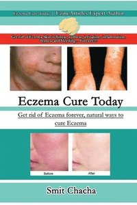 bokomslag Eczema Cure Today - Get rid of Eczema forever natural ways to cure Eczema