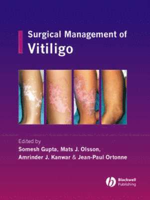 Somesh Gupta, Mats J. Olsson, Amrinder J. Kanwar, Jean-Paul Ortonne - Surgical Management of Vitiligo, Inbunden