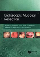 bokomslag Endoscopic Mucosal Resection