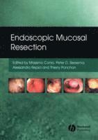 bokomslag Endoscopic Mucosal Resection