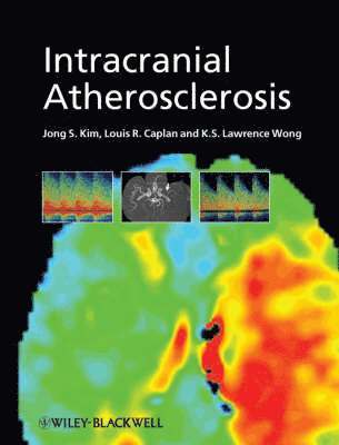 bokomslag Intracranial Atherosclerosis