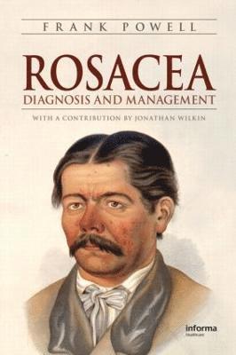 bokomslag Rosacea