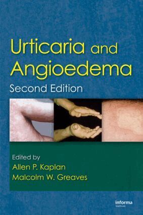Allen Kaplan, Malcolm Greaves, Allen Kaplan, Malcolm W. Greaves - Urticaria and Angioedema, Inbunden