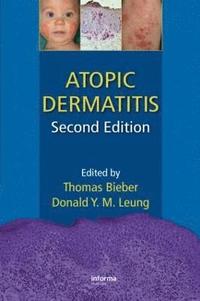 bokomslag Atopic Dermatitis