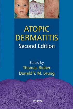 Thomas Bieber, Donald Y. M. Leung - Atopic Dermatitis, Inbunden