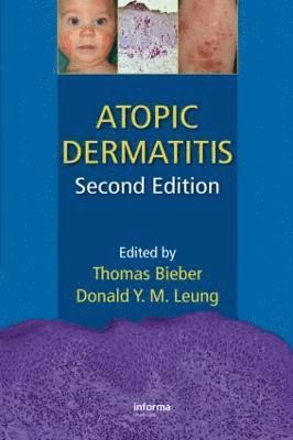 Atopic Dermatitis 1