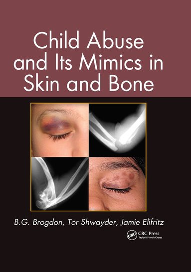 B. G. Brogdon, Tor Shwayder, Jamie Elifritz - Child Abuse and its Mimics in Skin and Bone, Inbunden