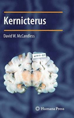 Kernicterus 1