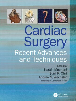 Narain Moorjani, Sunil K Ohri, Andrew Wechsler, UK) Moorjani, Narain (Papworth Hospital, Cambridge, UK) Ohri, Sunil K (Southampton University Hospital, USA) Wechsler, Andrew (Drexel University College of Medicine, Philadelphia, Pennsylvania, Sunil K. Ohri - Cardiac Surgery, Inbunden