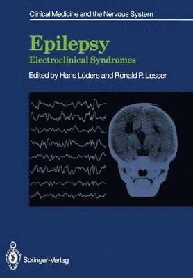 Epilepsy