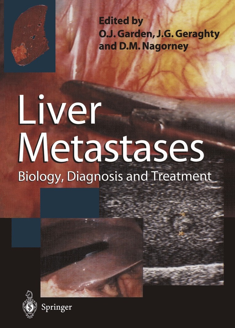 Liver Metastases 1