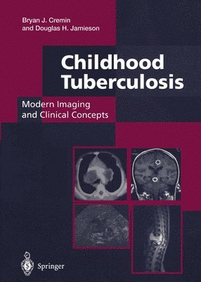 Childhood Tuberculosis: Modern Imaging and Clinical Concepts 1