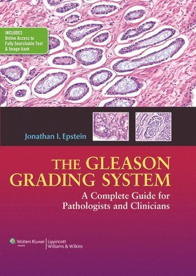 The Gleason Grading System 1