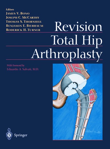 James V. Bono, Joseph C. McCarthy, Thomas S. Thornhill, Benjamin E. Bierbaum, Roderick H. Turner - Revision Total Hip Arthroplasty, Häftad