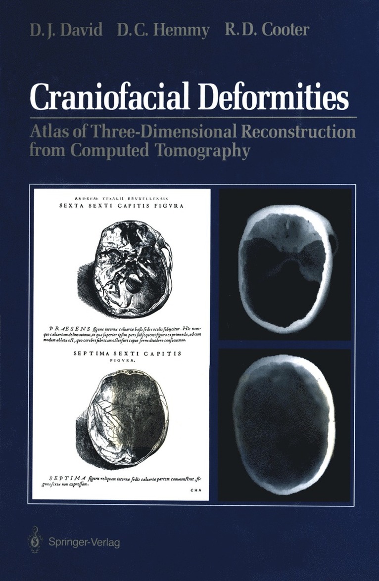 David J. David, David C. Hemmy, Rodney D. Cooter - Craniofacial Deformities, Häftad