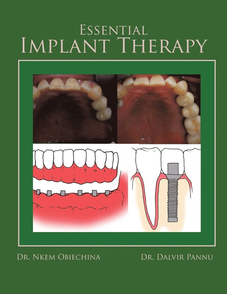 Dr. Nkem Obiechina, Dr. Dalvir Pannu, Nkem Obiechina, Dalvir Pannu - Essential Implant Therapy, Häftad