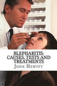 Blepharitis: Causes, Tests and Treatment 1